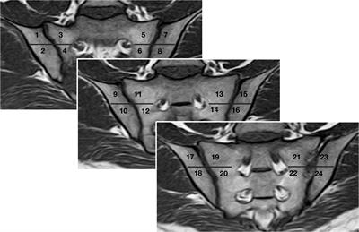 Zero echo time MRI improved detection of erosions and sclerosis in the sacroiliac joint in comparison with LAVA-flex